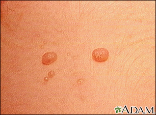 Molusco contagioso - imagem aproximada