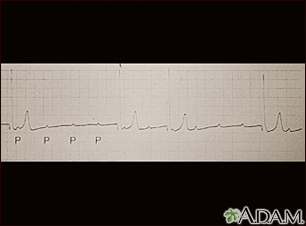 Bloqueio atrioventricular, rastreamento por ECG