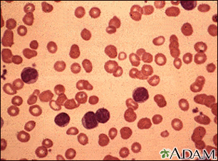 Leucemia linfocítica crônica - visualização microscópica