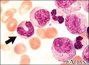 Leucemia mielocítica crônica - visualização microscópica