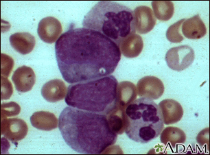 Leucemia mielocítica crônica