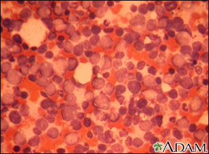 Leucemia mielocítica crônica