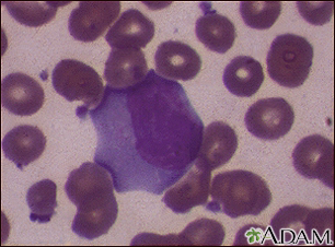 Mononucleose infecciosa nº 3