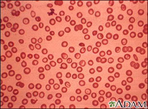 Talassemia minor