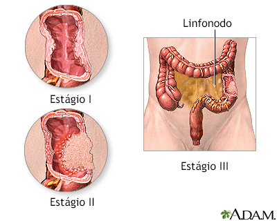 Incisão