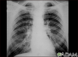 Pneumoconiose dos mineiros de carvão - estágio II