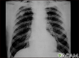 Pneumoconiose dos mineiros de carvão - estágio II