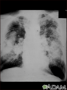 Pneumoconiose dos mineiros de carvão, complicada