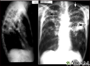 Tuberculose, avançada - radiografias do tórax