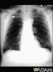 Nódulo pulmonar - radiografia frontal do tórax