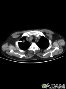 Nódulo pulmonar, único - tomografia computadorizada