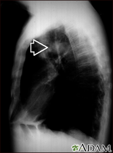 Massa pulmonar - raio-X do tórax de vista lateral