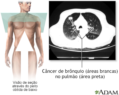 Câncer nos brônquios - tomografia computadorizada (TC)