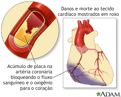 Infarto agudo do miocárdio