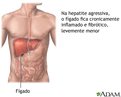 Hepatite crônica