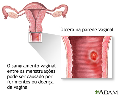 sangramento entre menstruações