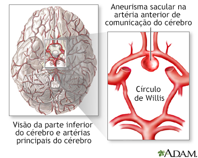 Aneurisma cerebral