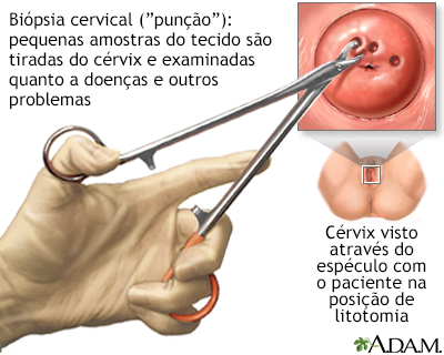 Biópsia cervical