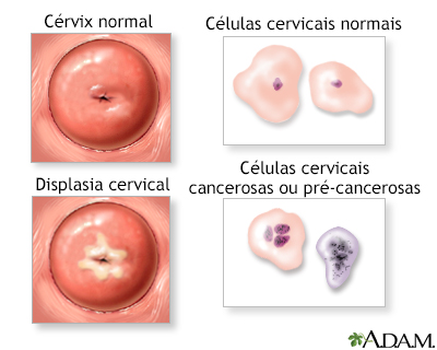 Neoplasia cervical