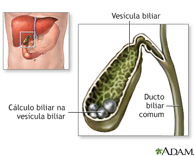 Colelitíase