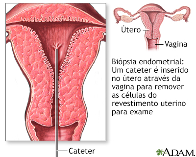 Biópsia endometrial