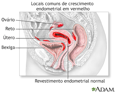 Endometriose