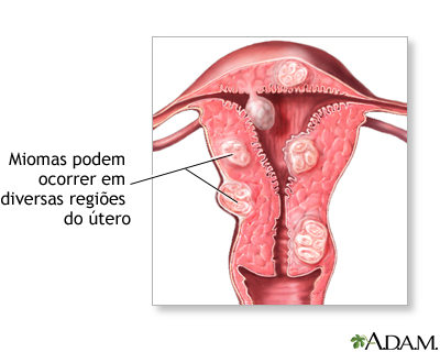 Tumores fibroides