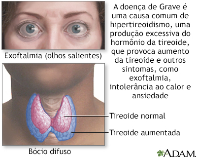 Doença de graves