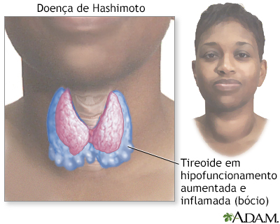 Doença de Hashimoto (tireoidite crônica)