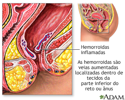 Hemorroidas