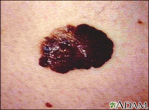 Câncer de pele, melanoma - lesão escura e saliente