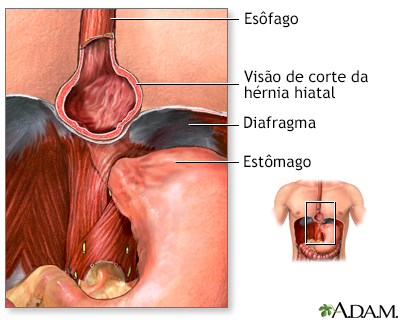 Hérnia de hiato