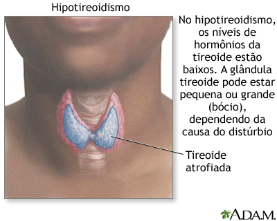 Hipotireoidismo