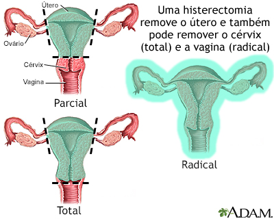 Histerectomia