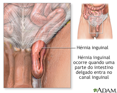 Hérnia inguinal