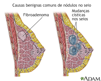 Fibroadenoma mamário: o que você precisa saber - Clínica Viver