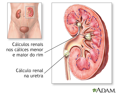 Nefrolitíase