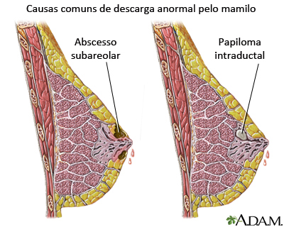 Secreção Anormal do Mamilo