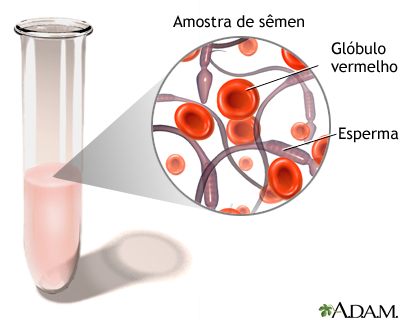 Sangue no sêmen