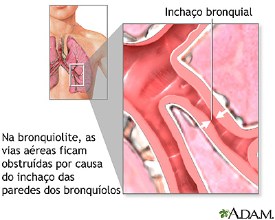 Bronquiolite