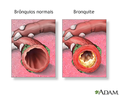 Bronquite