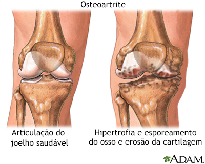 Osteoartrite