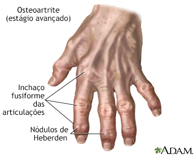 Osteoartrite