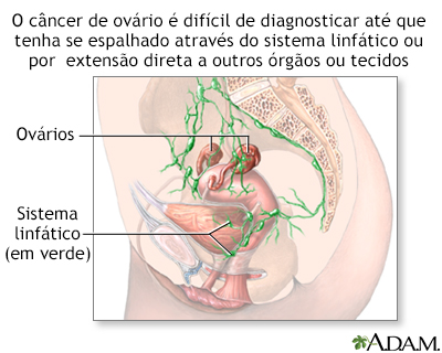 Perigos do câncer de ovário