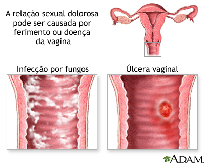 Causas de relação sexual dolorosa