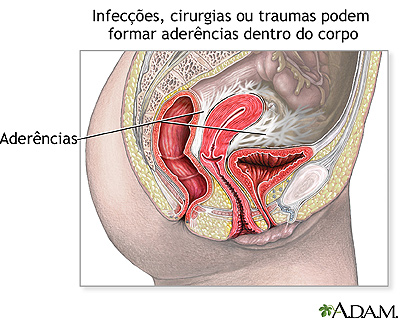 Aderência pélvica