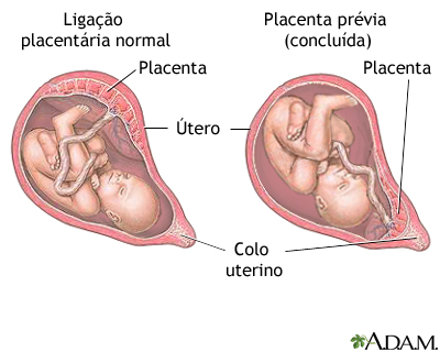 Placenta prévia