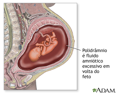 Poliidrâmnio