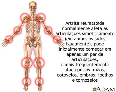 Artrite reumatoide