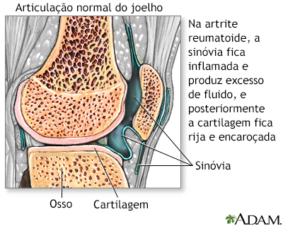 Artrite Reumatoide